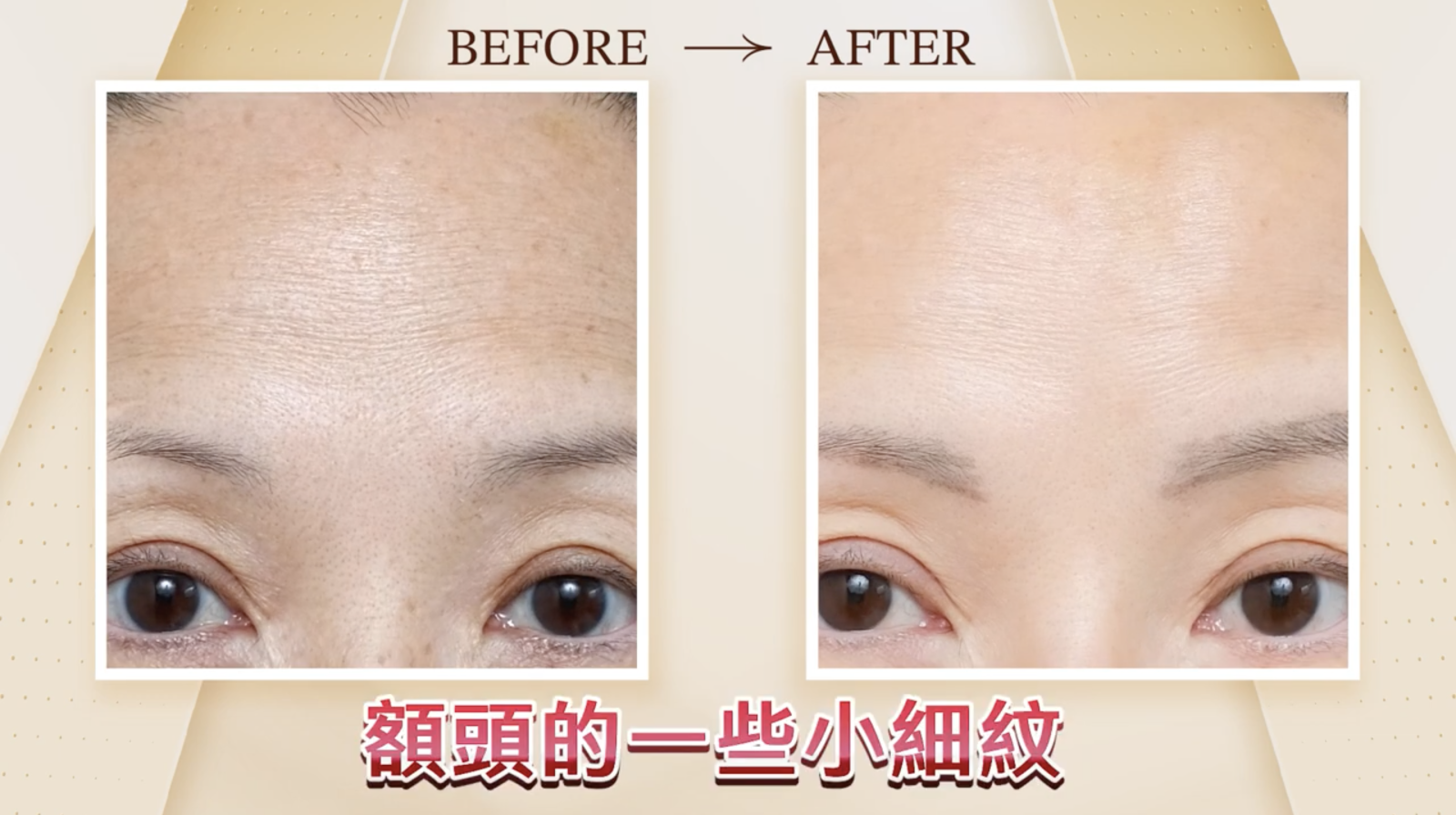 Picosure PRO鉑金蜂巢皮秒所創造的「空泡效應」可以有效刺激真皮層的膠原蛋白新生