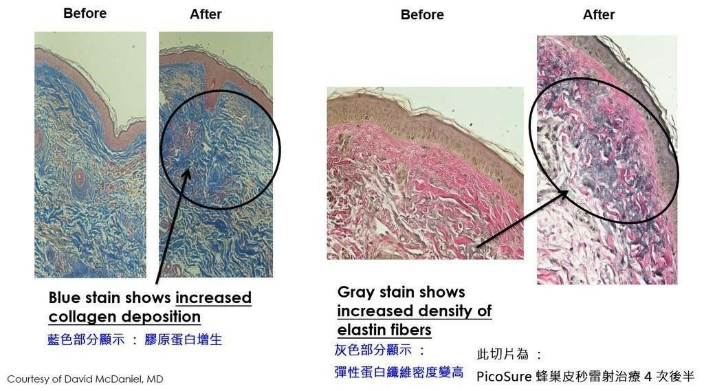 皮秒雷射加上「蜂巢透鏡（Focus Lens）」一起施打，可以在皮膚表皮產生「空泡效應」刺激膠原蛋白新生