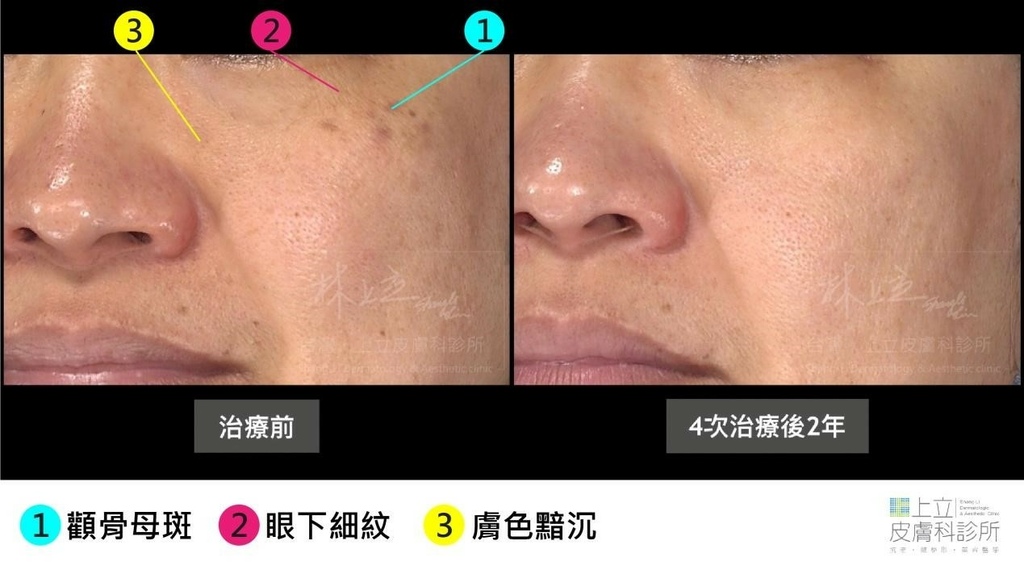 PicoSure 755蜂巢皮秒雷射4次治療2年後，皮膚仍維持很好的狀態。