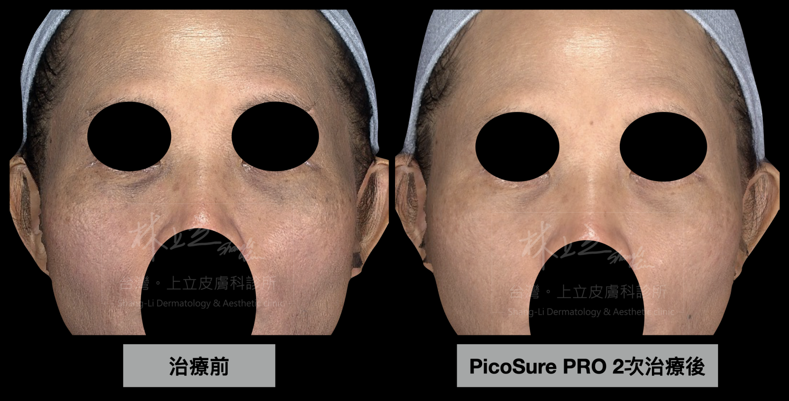 即使在處理顏色更深、色素面接更大的棘手問題，也只需要2次治療就取得很好的改善效果。