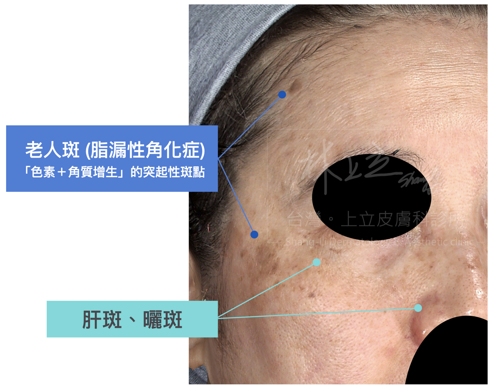 很多人的臉部都不會只有一種斑點