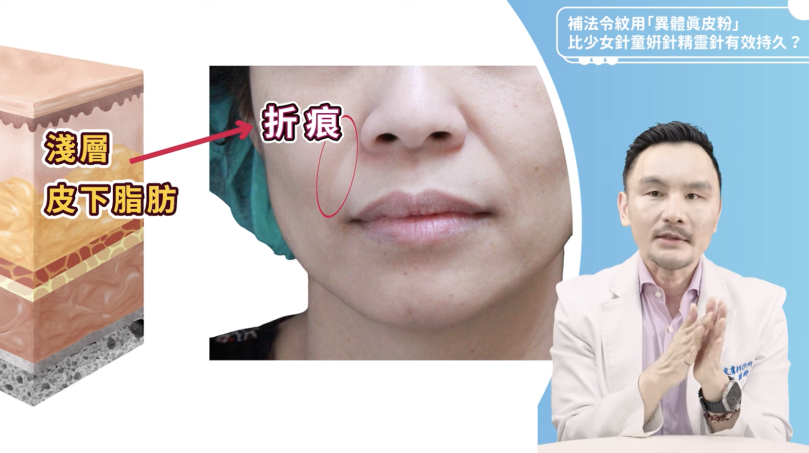 淺層流失（真皮層、淺層脂肪）會造成皮膚表面出現二條線性的法令紋摺痕。