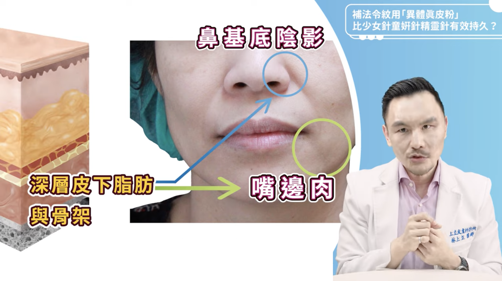 深層流失（深層脂肪、骨架）則會讓鼻基底周圍出現一塊凹陷陰影，甚至還有輕微的嘴邊肉。