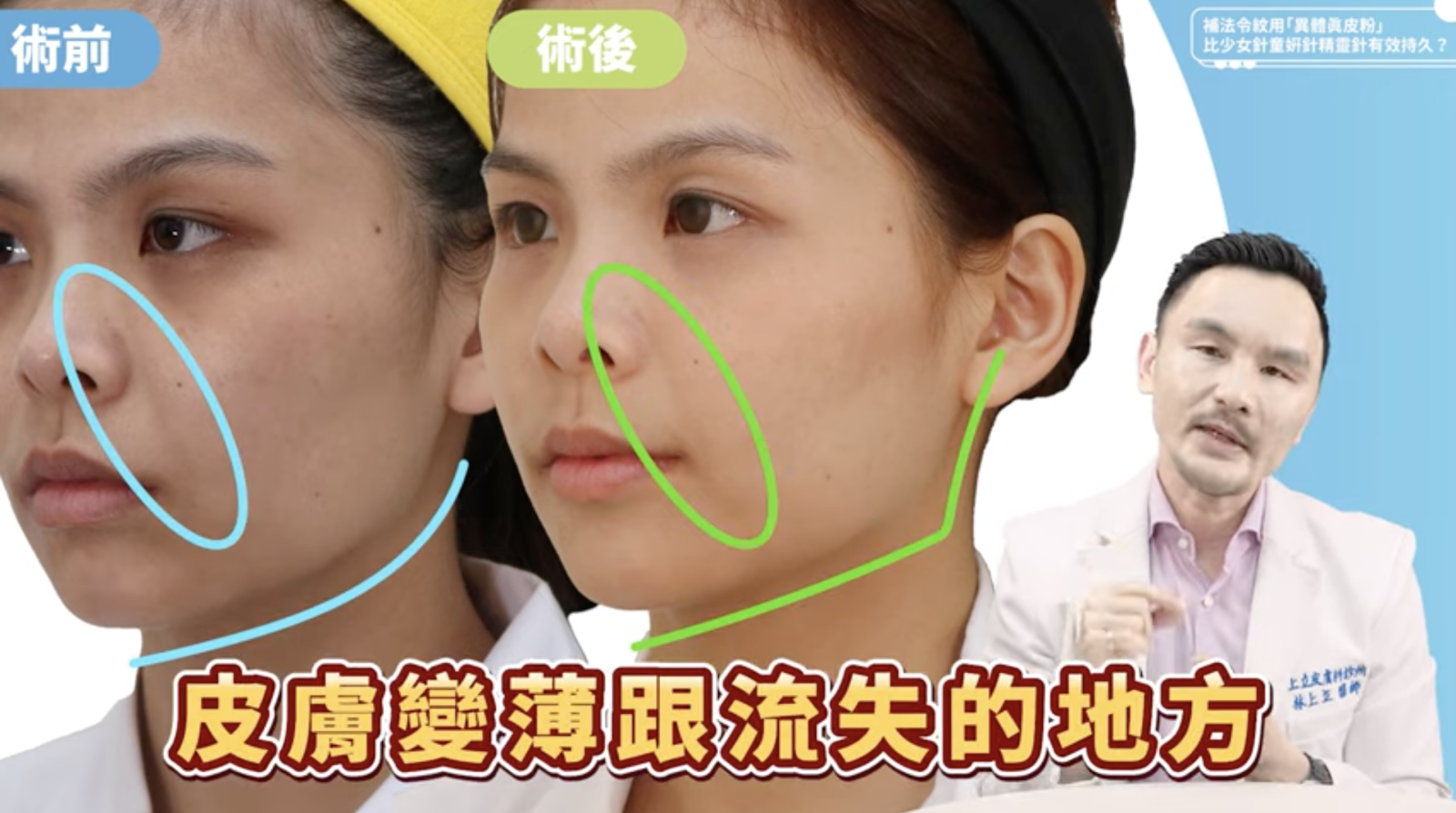 在處理多層次流失的法令紋，林上立醫師利用ELLANS&Eacute;洢蓮絲先解決了上顎骨支撐不足的問題