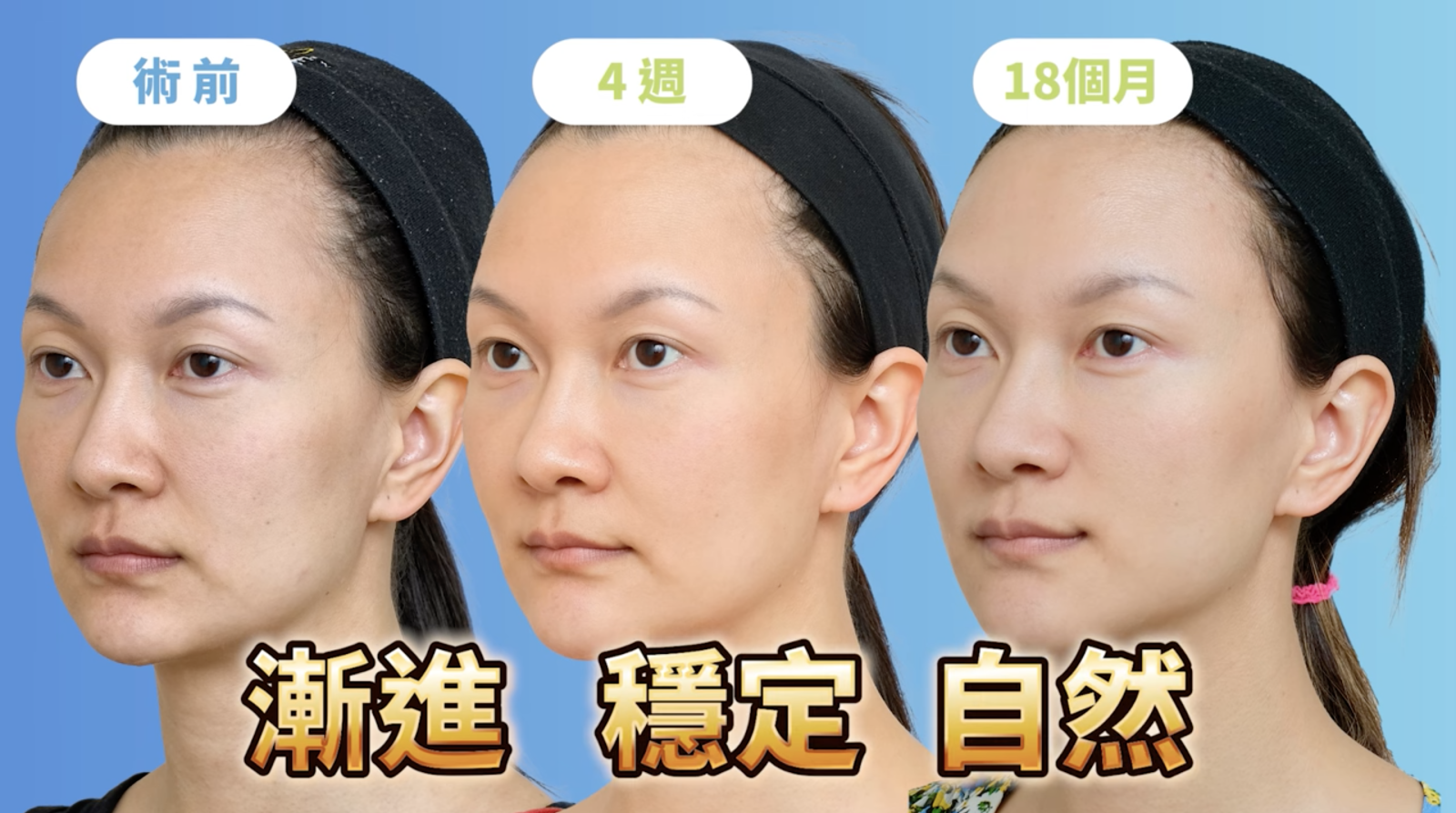 在這個案例中，林上立醫師針對不同部位的流失，同時使用ELLANS&Eacute;洢蓮絲和Aesthefill艾麗斯透過膠原蛋白新生來達到支撐的效果