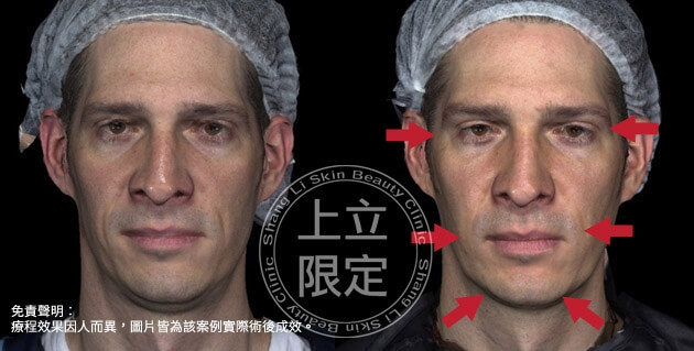 兩頰拉提與下巴雕塑