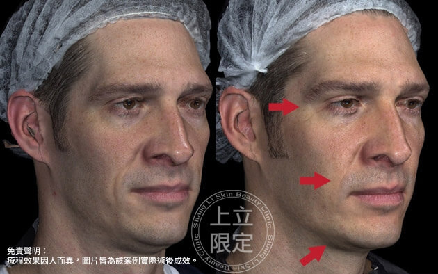 兩頰拉提與下巴雕塑