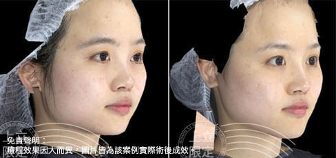 3D影像圖充分顯示頭型的改變，咀嚼肌也跟著變小
