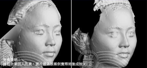 3D影像圖充分顯示頭型的改變，咀嚼肌也跟著變小